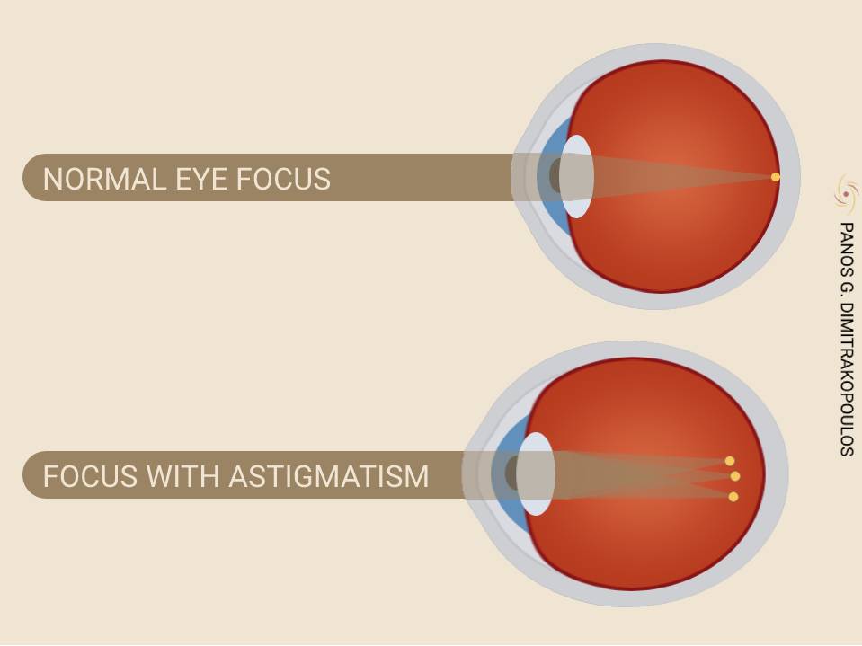 Eye focus with astigmatism