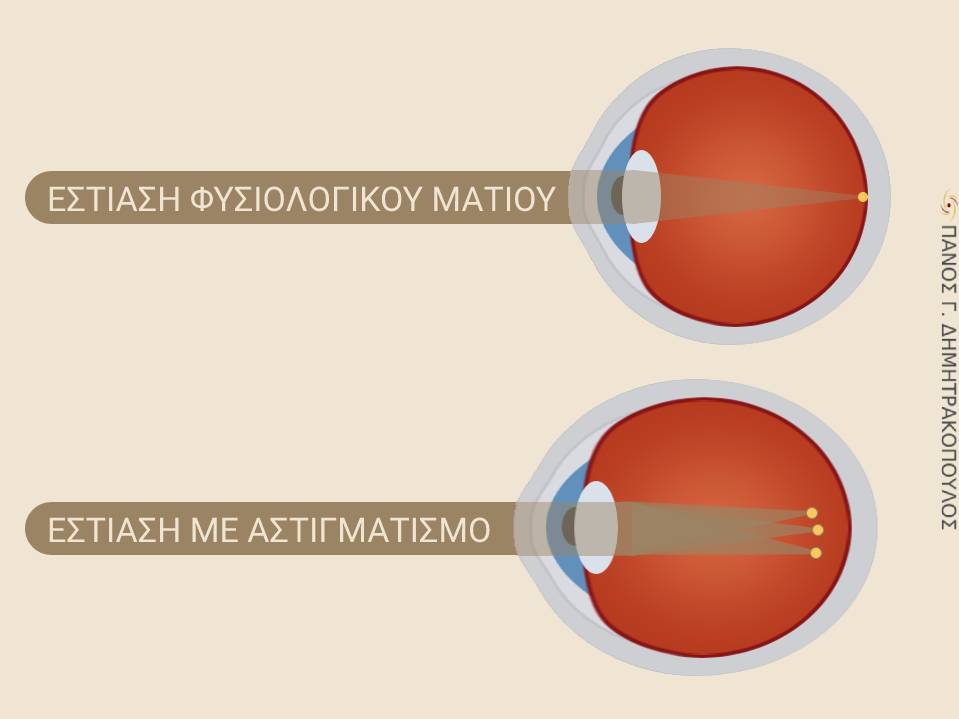 Εστίαση ματιού με αστιγματισμό