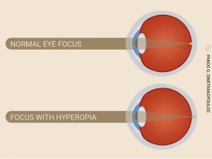Hyperopia