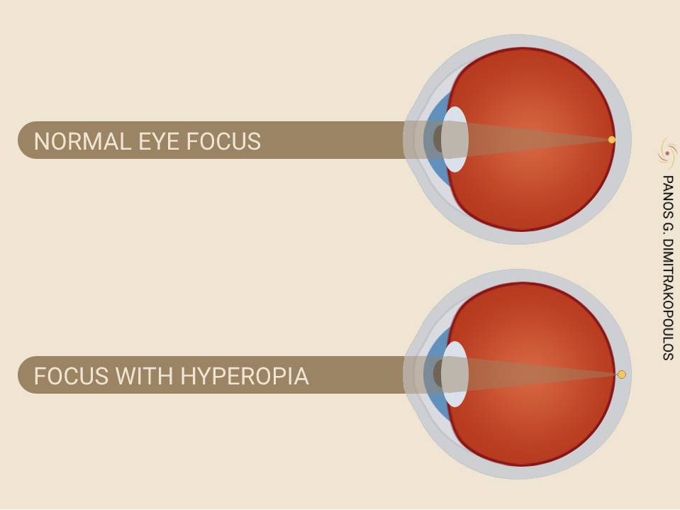 Eye focus with hyperopia