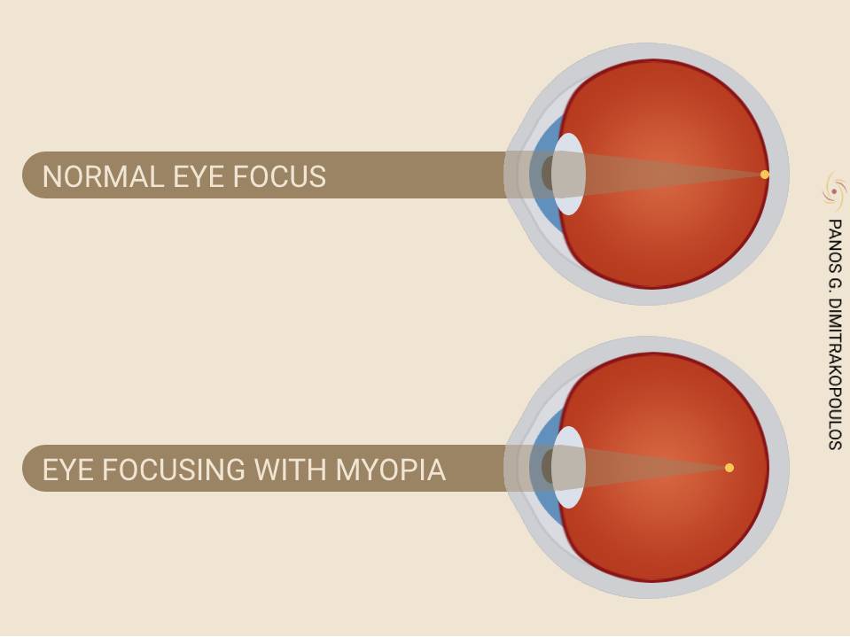 Eye focus with myopia