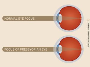 Presbyopia