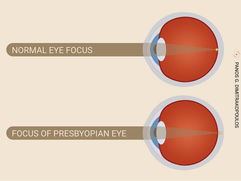 Focusing of a presbyopic eye