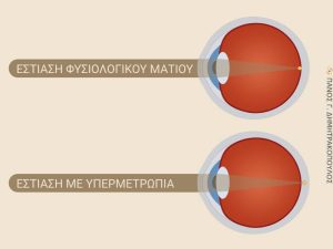Υπερμετρωπία